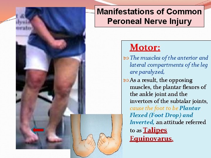 Manifestations of Common Peroneal Nerve Injury Motor: The muscles of the anterior and lateral