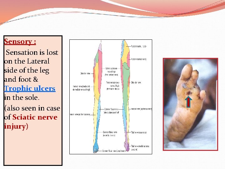 Sensory : Sensation is lost on the Lateral side of the leg and foot
