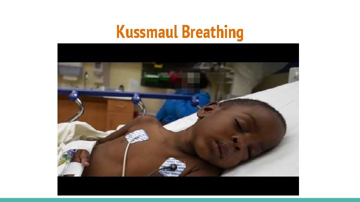Kussmaul Breathing 