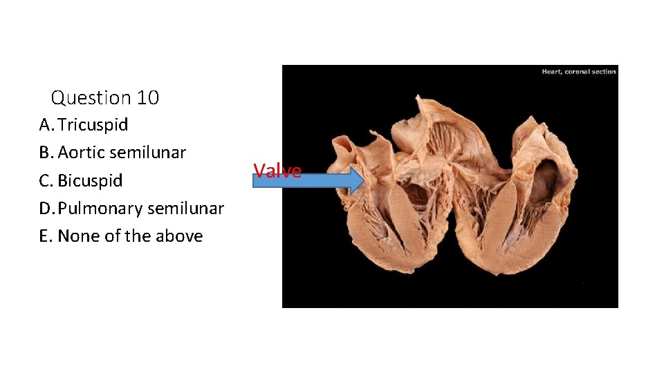 Question 10 A. Tricuspid B. Aortic semilunar C. Bicuspid D. Pulmonary semilunar E. None