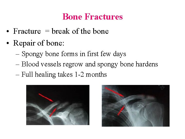 Bone Fractures • Fracture = break of the bone • Repair of bone: –