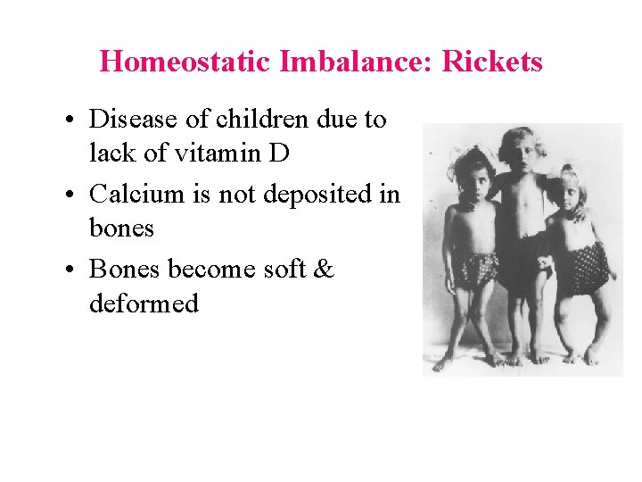 Homeostatic Imbalance: Rickets Homeostatic Imbalances • Disease of children due to lack of vitamin