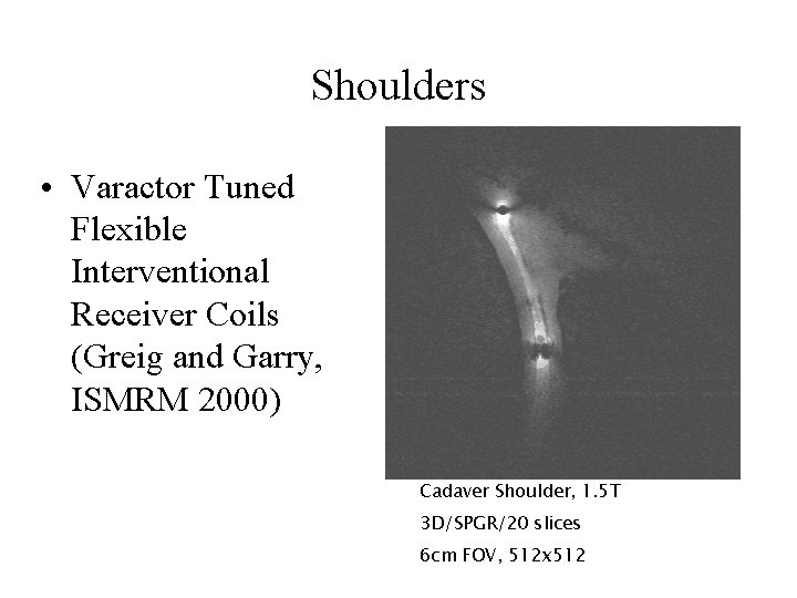 Shoulders • Varactor Tuned Flexible Interventional Receiver Coils (Greig and Garry, ISMRM 2000) Cadaver