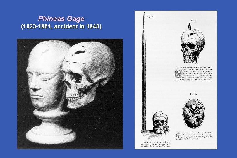 Phineas Gage (1823 -1861, accident in 1848) 
