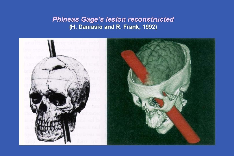 Phineas Gage’s lesion reconstructed (H. Damasio and R. Frank, 1992) 