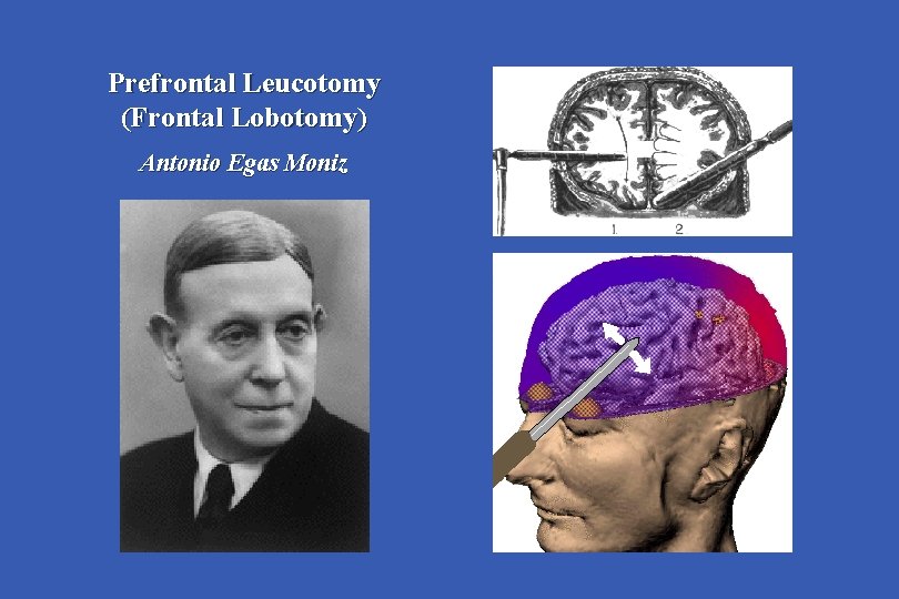 Prefrontal Leucotomy (Frontal Lobotomy) Antonio Egas Moniz 