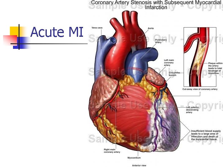 Acute MI 