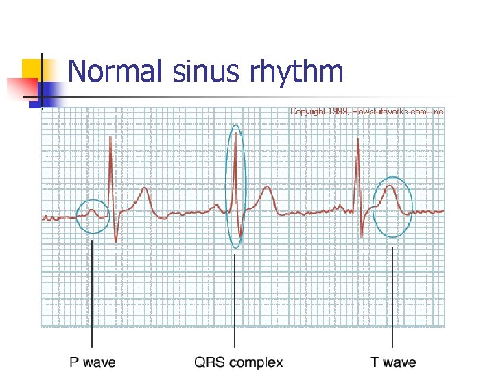 Normal sinus rhythm 