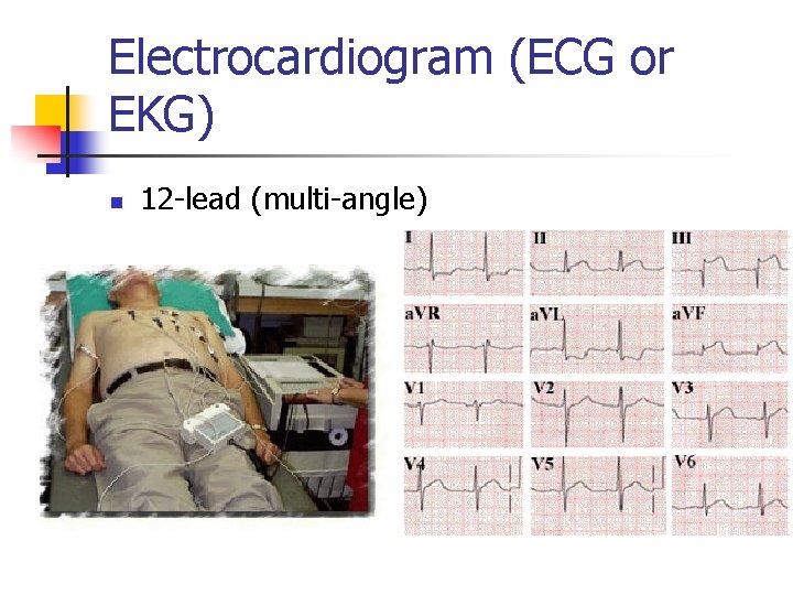 Electrocardiogram (ECG or EKG) n 12 -lead (multi-angle) 