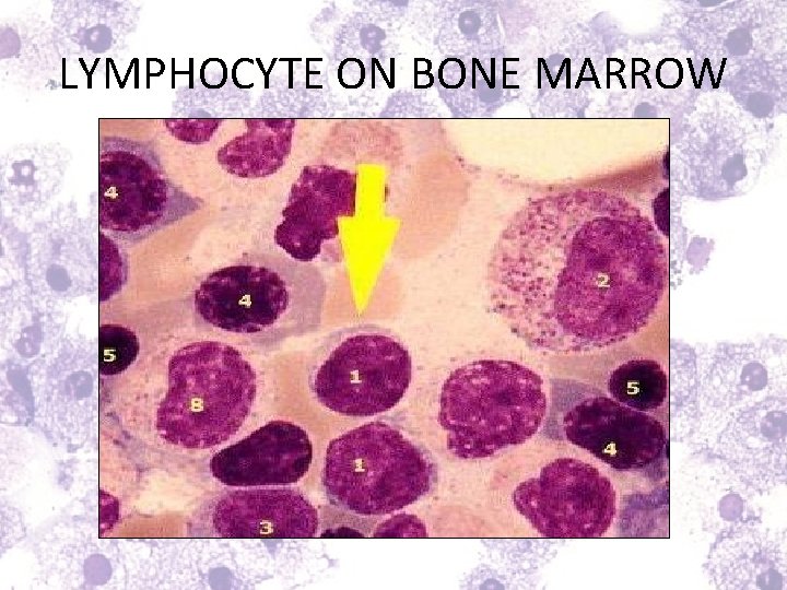 LYMPHOCYTE ON BONE MARROW 