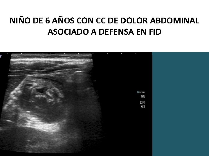 NIÑO DE 6 AÑOS CON CC DE DOLOR ABDOMINAL ASOCIADO A DEFENSA EN FID