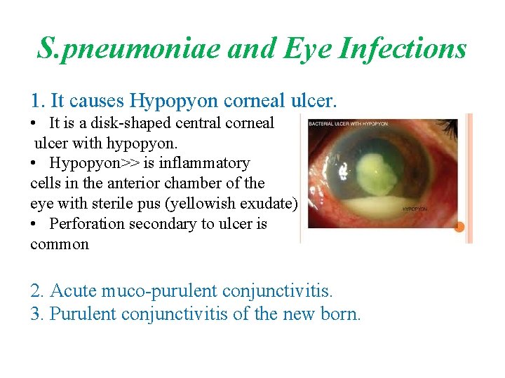 S. pneumoniae and Eye Infections 1. It causes Hypopyon corneal ulcer. • It is