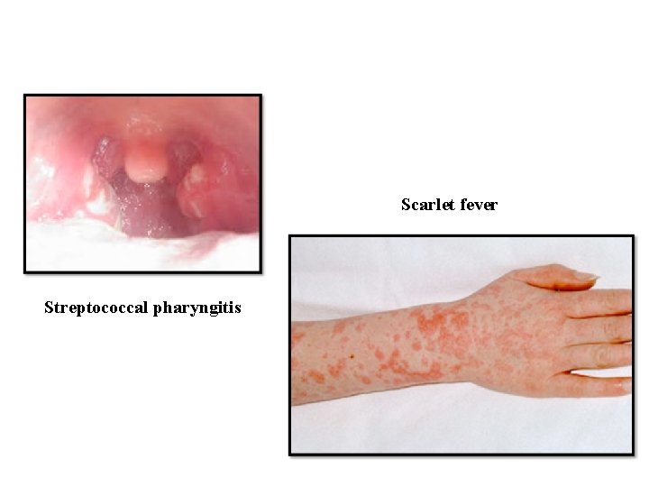 Scarlet fever Streptococcal pharyngitis 