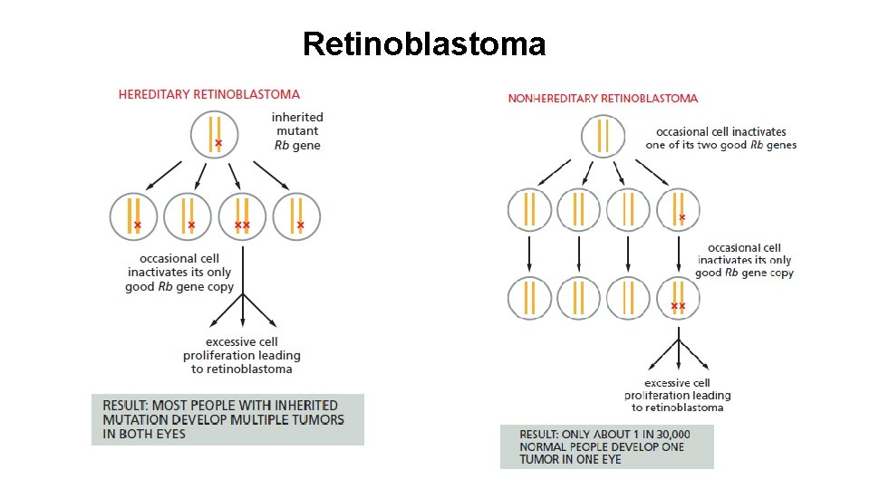 Retinoblastoma 