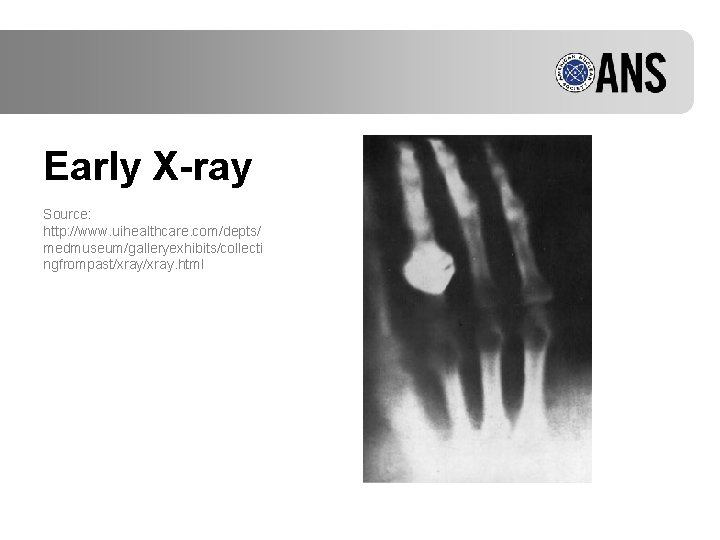 Early X-ray Source: http: //www. uihealthcare. com/depts/ medmuseum/galleryexhibits/collecti ngfrompast/xray. html 