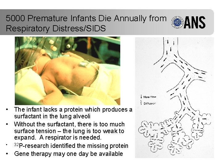 5000 Premature Infants Die Annually from Respiratory Distress/SIDS • The infant lacks a protein