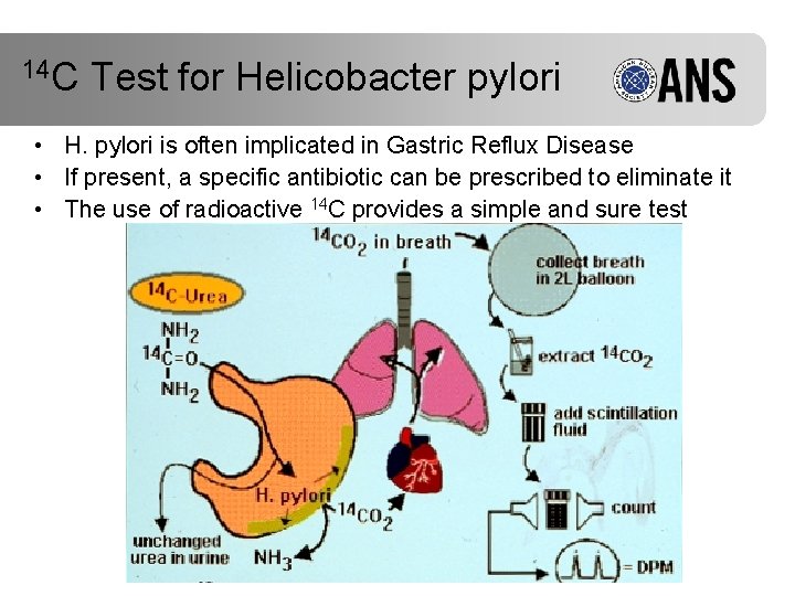 14 C Test for Helicobacter pylori • H. pylori is often implicated in Gastric