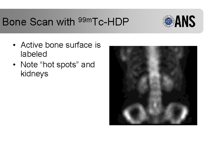 Bone Scan with 99 m. Tc-HDP • Active bone surface is labeled • Note