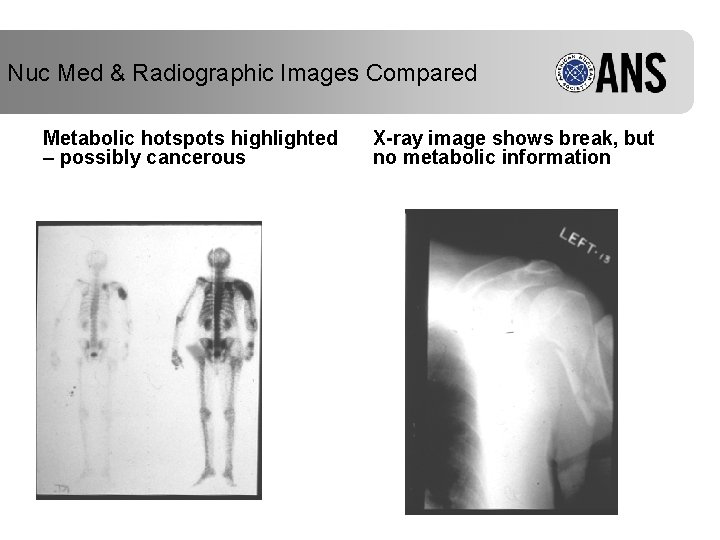 Nuc Med & Radiographic Images Compared Metabolic hotspots highlighted – possibly cancerous X-ray image