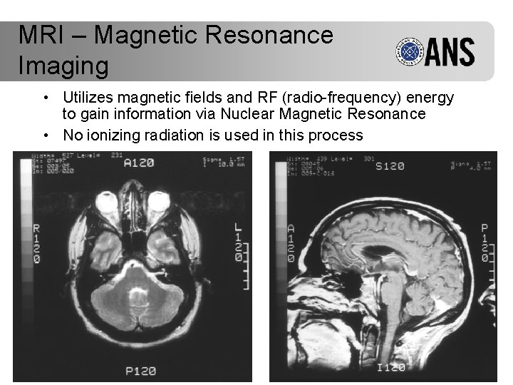 MRI – Magnetic Resonance Imaging • Utilizes magnetic fields and RF (radio-frequency) energy to