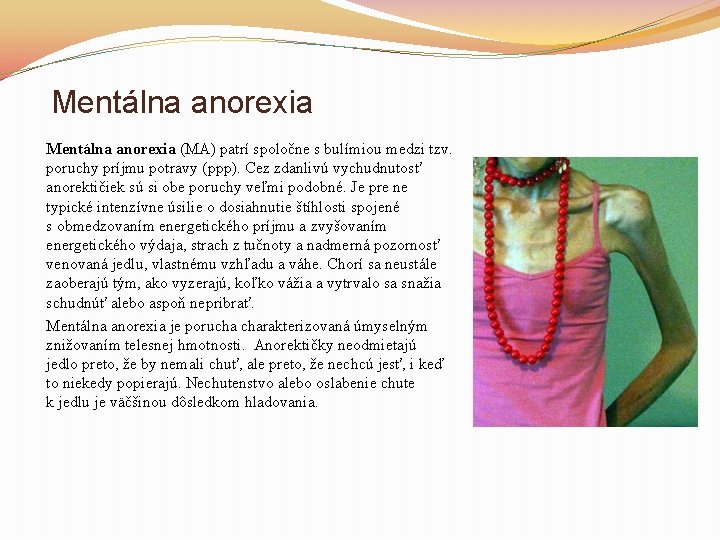 Mentálna anorexia (MA) patrí spoločne s bulímiou medzi tzv. poruchy príjmu potravy (ppp). Cez