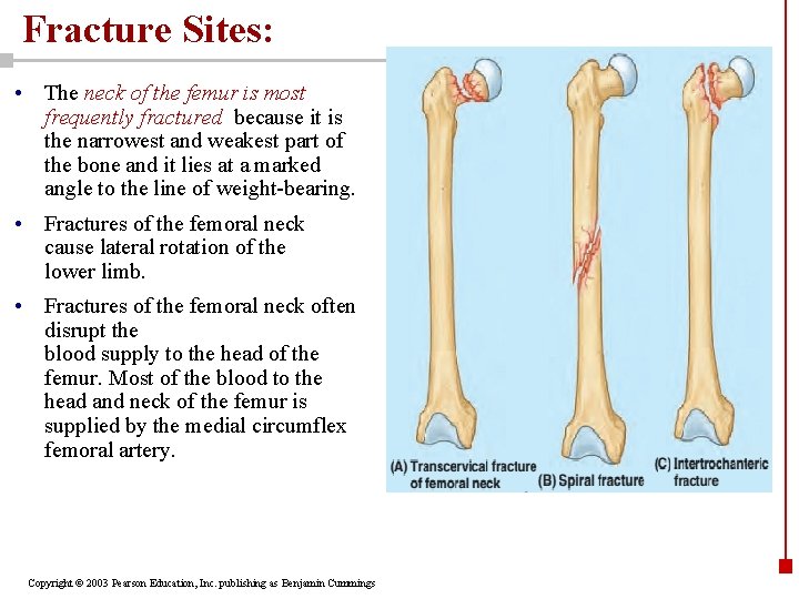 Fracture Sites: • The neck of the femur is most frequently fractured because it