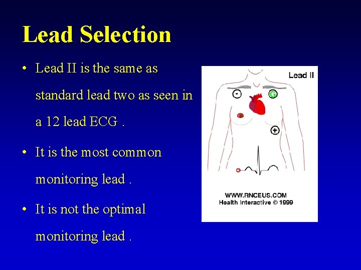 Lead Selection • Lead II is the same as standard lead two as seen