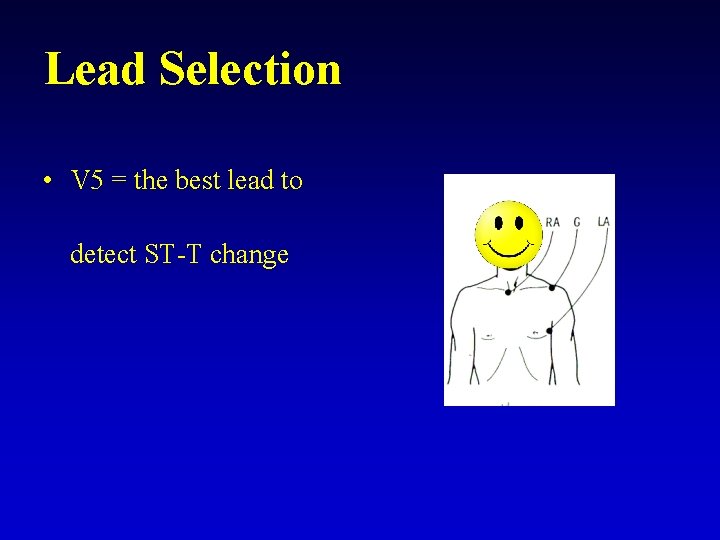 Lead Selection • V 5 = the best lead to detect ST-T change 