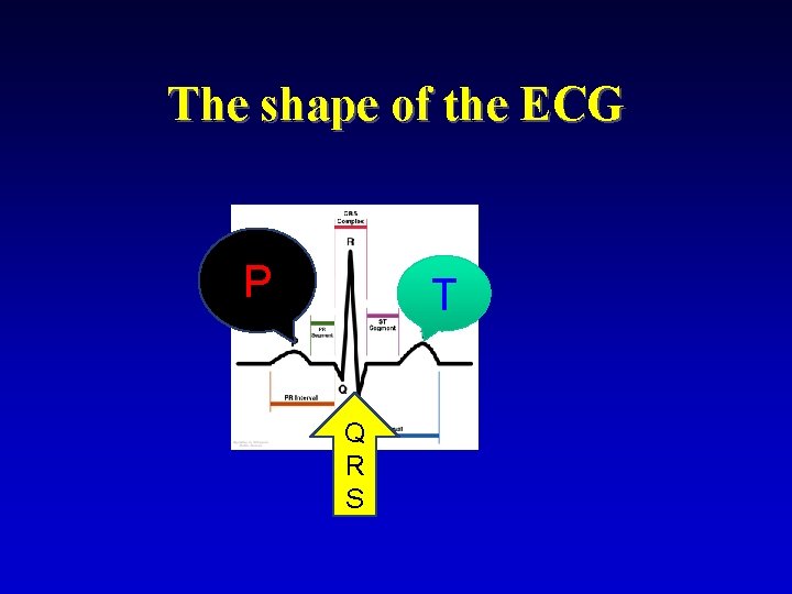The shape of the ECG P T Q R S 