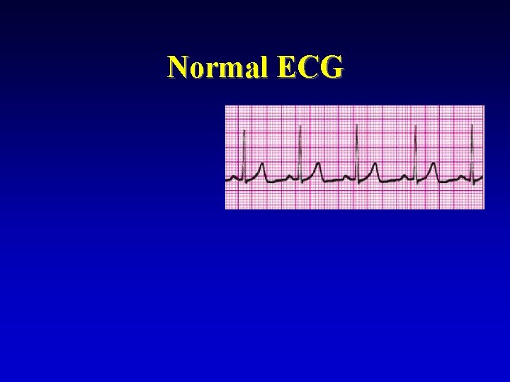 Normal ECG 