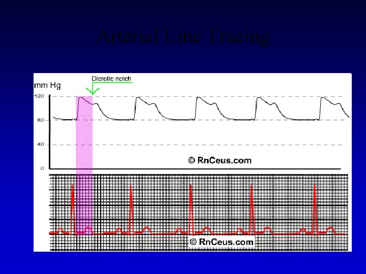 Arterial Line Tracing 
