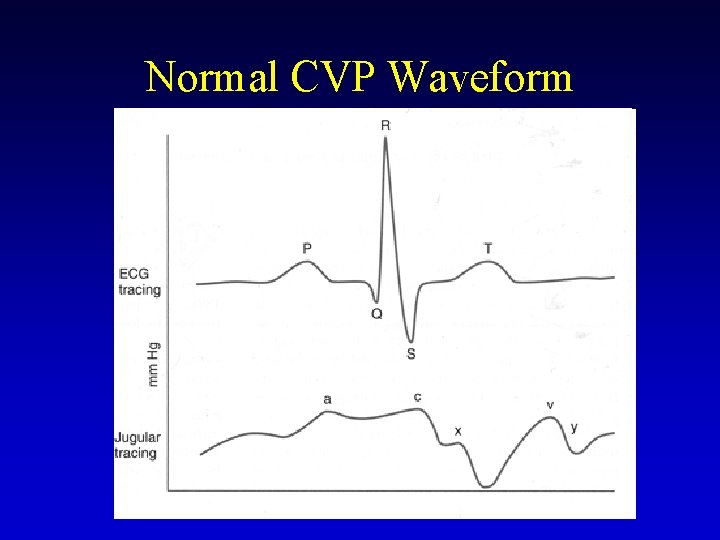 Normal CVP Waveform 