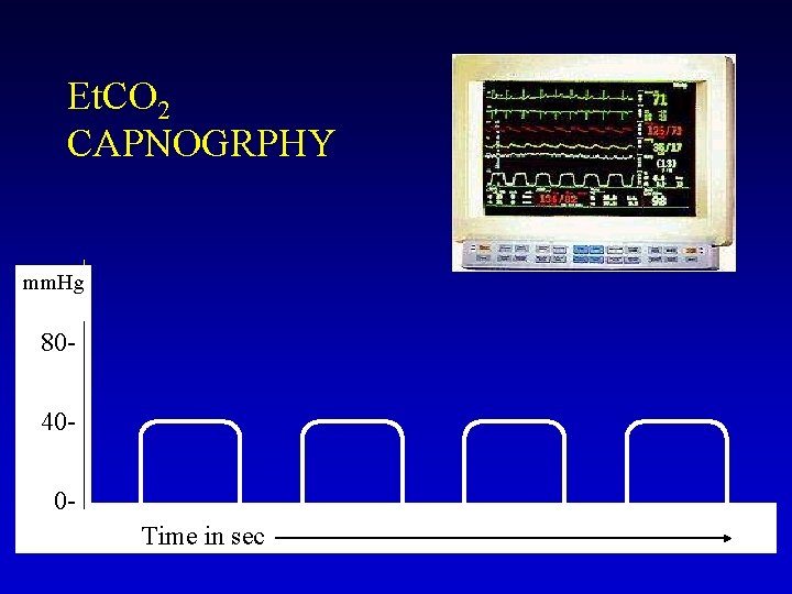 Et. CO 2 CAPNOGRPHY mm. Hg 80400 Time in sec 