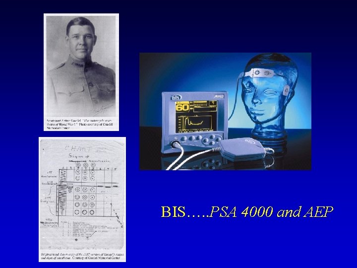 BIS…. . PSA 4000 and AEP 