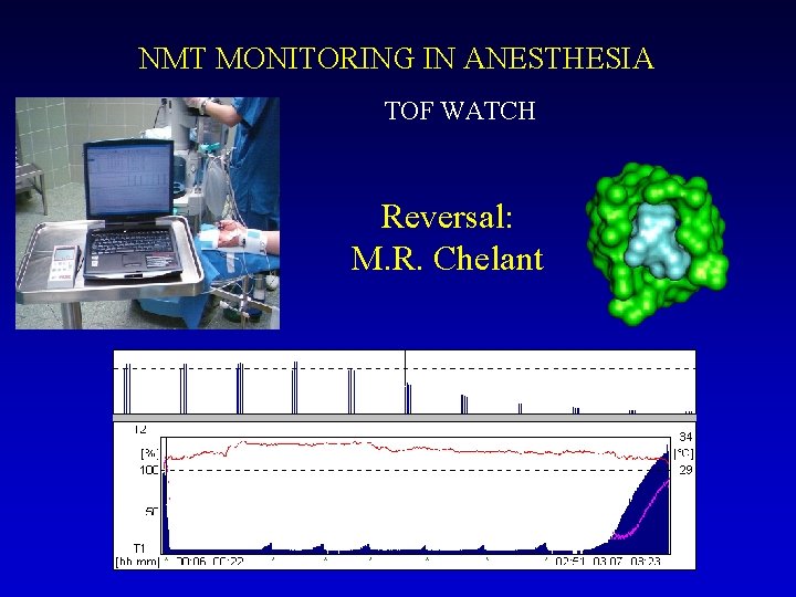 NMT MONITORING IN ANESTHESIA TOF WATCH Reversal: M. R. Chelant 