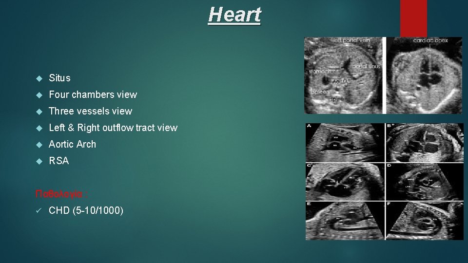 Heart Situs Four chambers view Three vessels view Left & Right outflow tract view