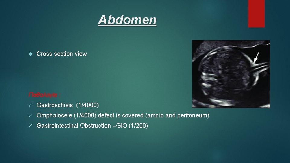 Abdomen Cross section view Παθολογία : ü Gastroschisis (1/4000) ü Omphalocele (1/4000) defect is