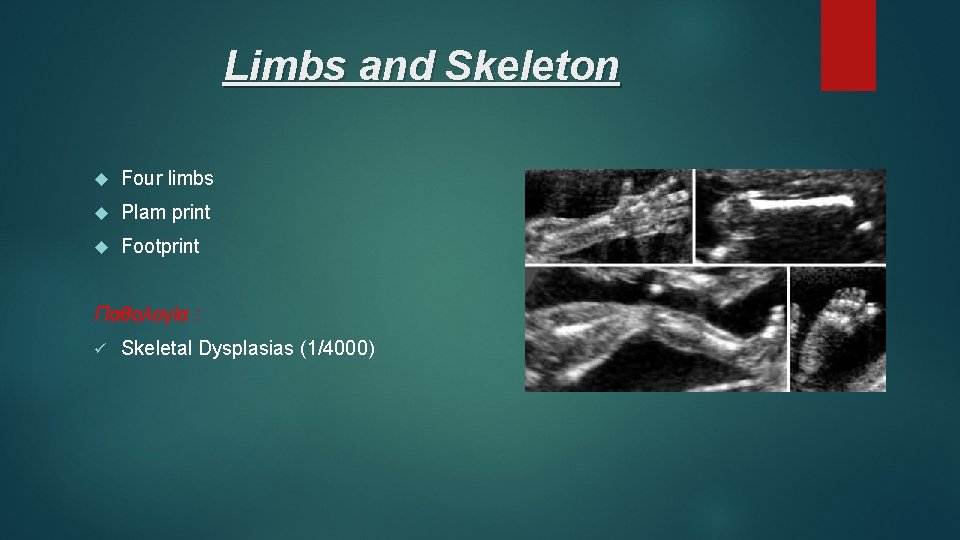 Limbs and Skeleton Four limbs Plam print Footprint Παθολογία : ü Skeletal Dysplasias (1/4000)