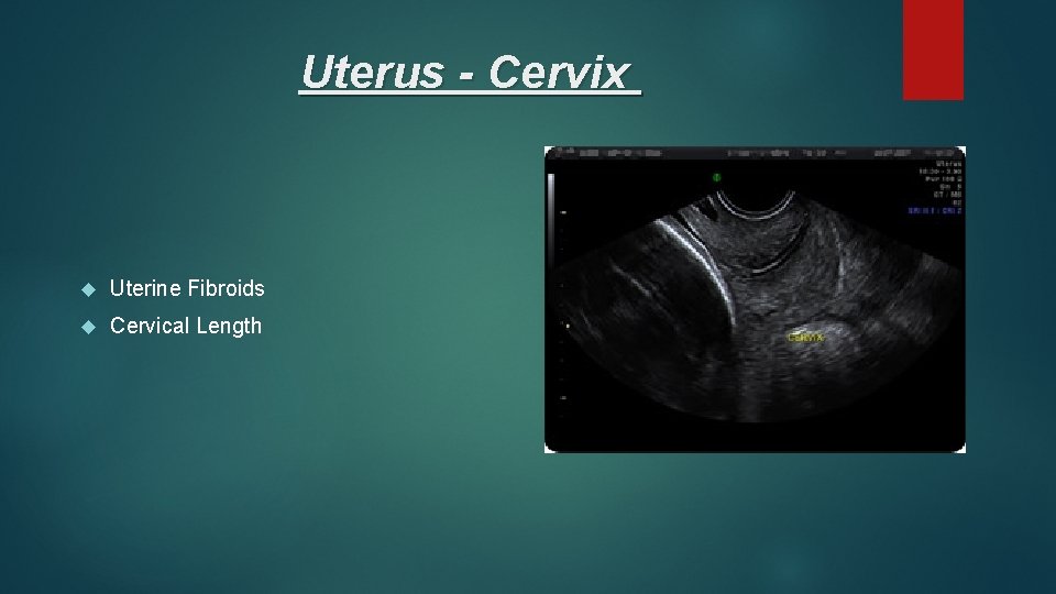 Uterus - Cervix Uterine Fibroids Cervical Length 