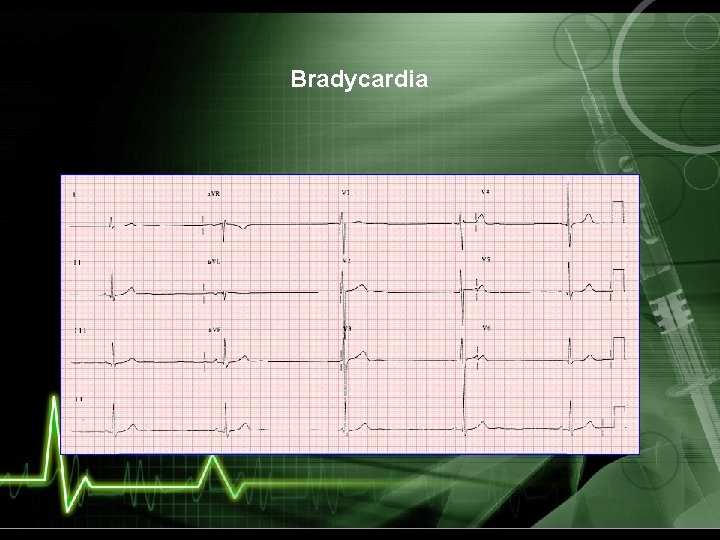 Bradycardia 