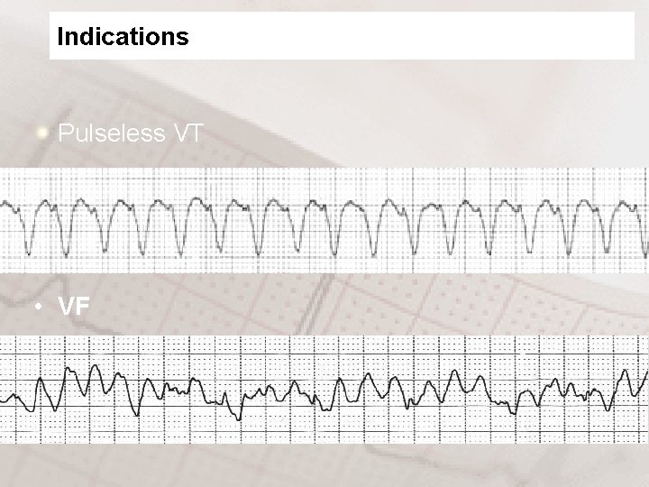 Indications Pulseless VT • VF 