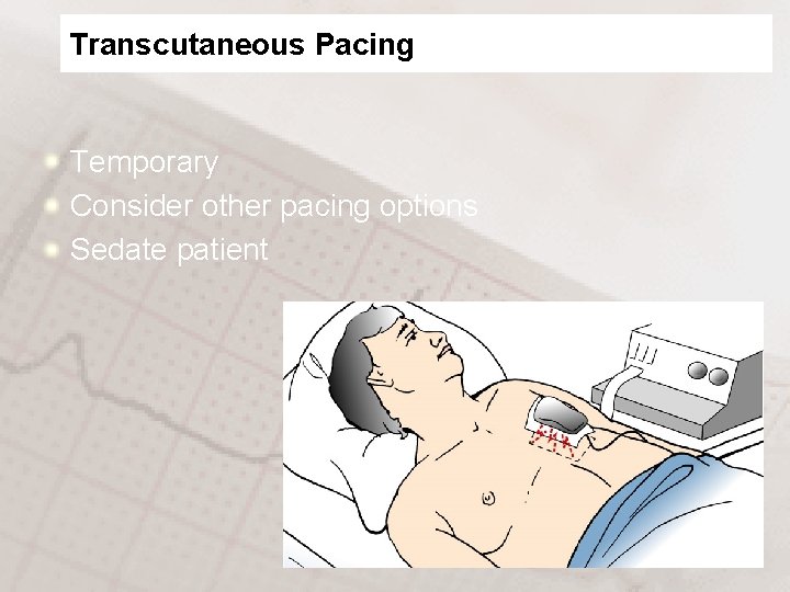 Transcutaneous Pacing Temporary Consider other pacing options Sedate patient 