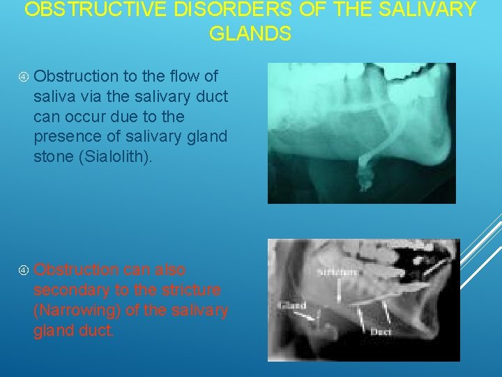 OBSTRUCTIVE DISORDERS OF THE SALIVARY GLANDS Obstruction to the flow of saliva via the OBSTRUCTIVE DISORDERS OF THE SALIVARY GLANDS Obstruction to the flow of saliva via the