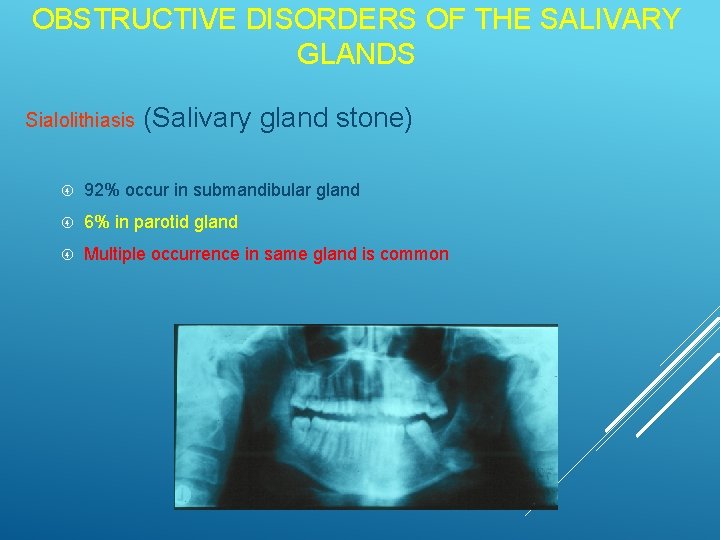 OBSTRUCTIVE DISORDERS OF THE SALIVARY GLANDS Sialolithiasis (Salivary gland stone) 92% occur in submandibular OBSTRUCTIVE DISORDERS OF THE SALIVARY GLANDS Sialolithiasis (Salivary gland stone) 92% occur in submandibular