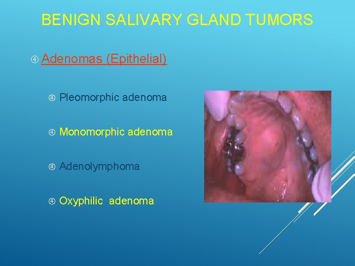 BENIGN SALIVARY GLAND TUMORS Adenomas (Epithelial) Pleomorphic adenoma Monomorphic adenoma Adenolymphoma Oxyphilic adenoma BENIGN SALIVARY GLAND TUMORS Adenomas (Epithelial) Pleomorphic adenoma Monomorphic adenoma Adenolymphoma Oxyphilic adenoma