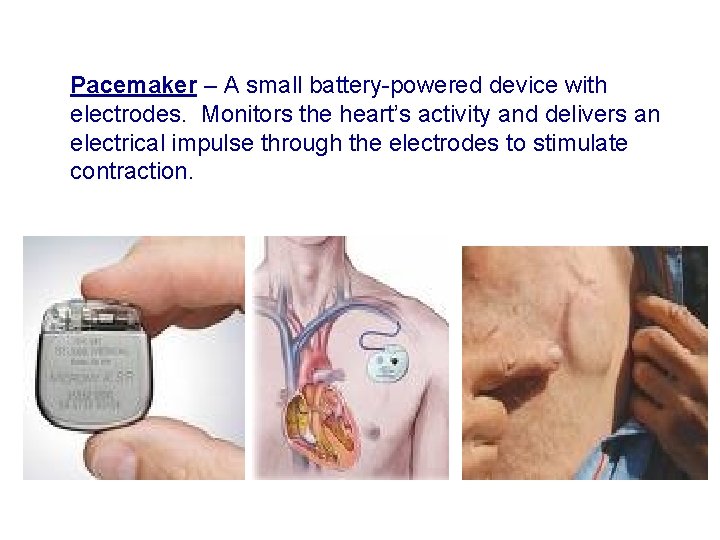  • Pacemaker – A small battery-powered device with electrodes. Monitors the heart’s activity