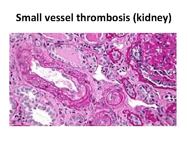 Small vessel thrombosis (kidney) 