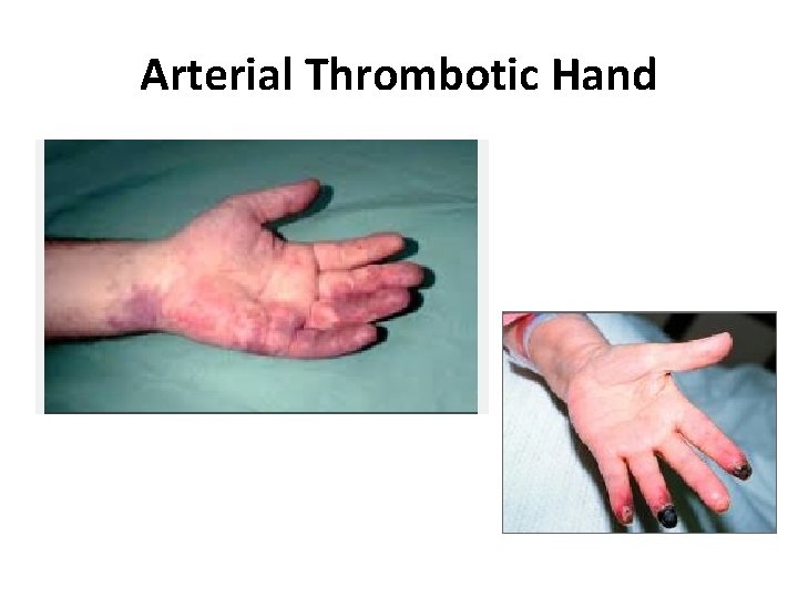 Arterial Thrombotic Hand 