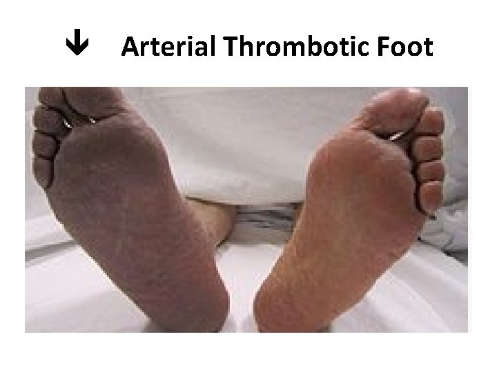  Arterial Thrombotic Foot 