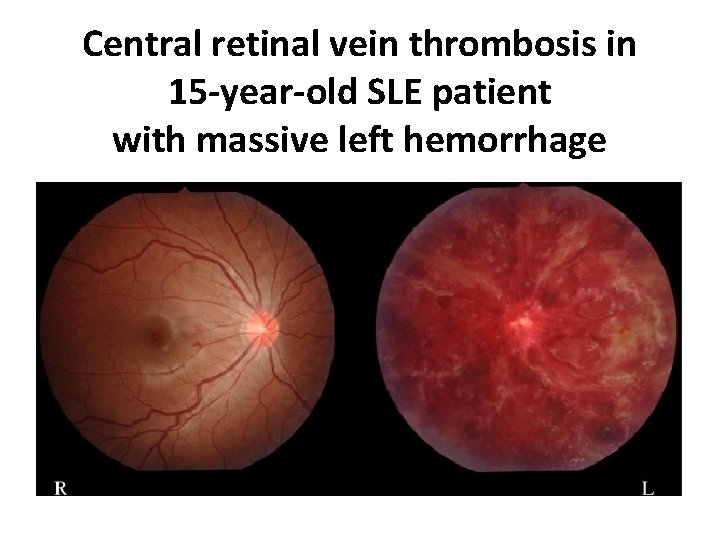 Central retinal vein thrombosis in 15 -year-old SLE patient with massive left hemorrhage 